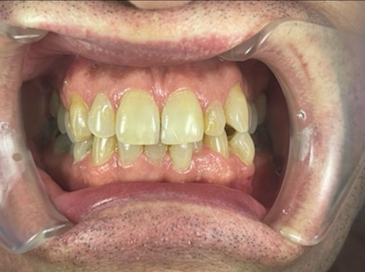 Before and after 1.1 Teeth Straightening Teignmouth