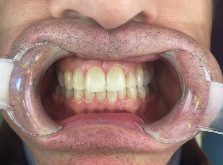 Teeth Straightening Teignmouth
