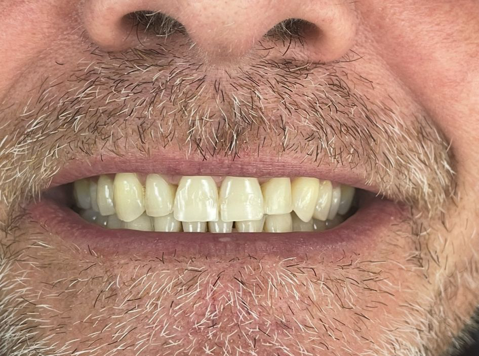 Teeth Straightening Teignmouth