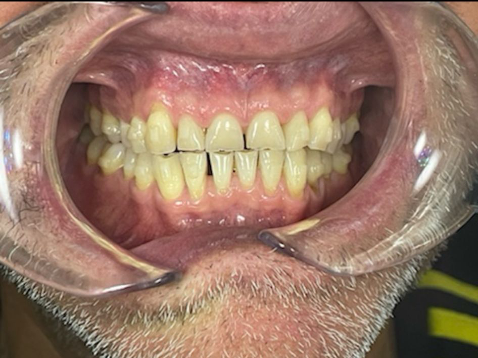 TS.1.2 Teeth Straightening Teignmouth