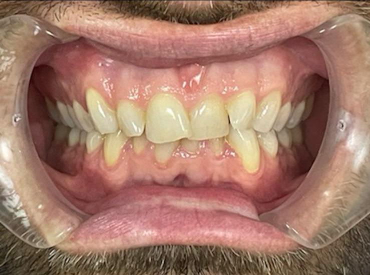 TS.2.1 Teeth Straightening Teignmouth