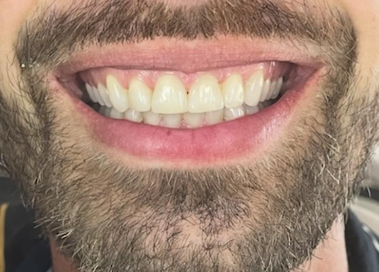 Teeth Straightening Teignmouth